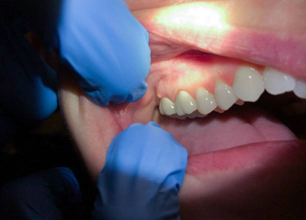 Best Emergency Dental Care for Broken or Chipped Teeth in Sa Conejo, CA
